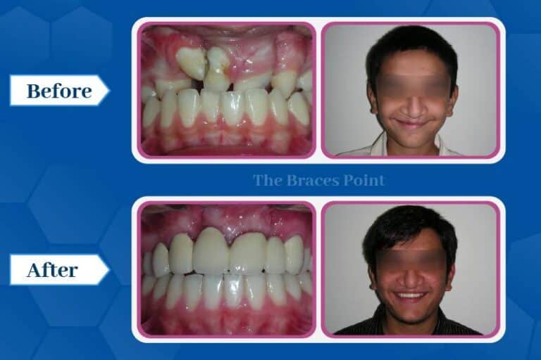 Braces for Cleft Lip And Palate Patients In Mumbai