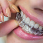 Braces Vs Invisalign: Find Out Which One Is Better For You