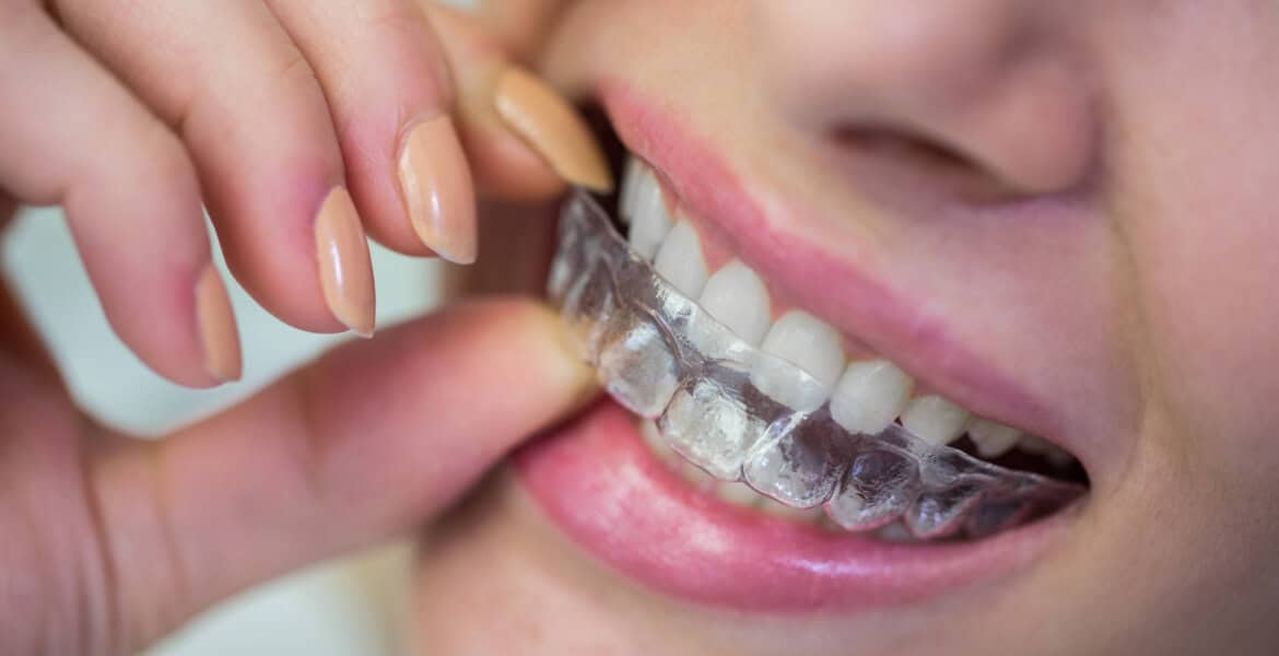 What Is The Invisalign Braces Cost In Mumbai? Find Out Here!