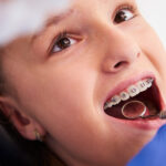 Comprehensive Guide To Braces For Kids