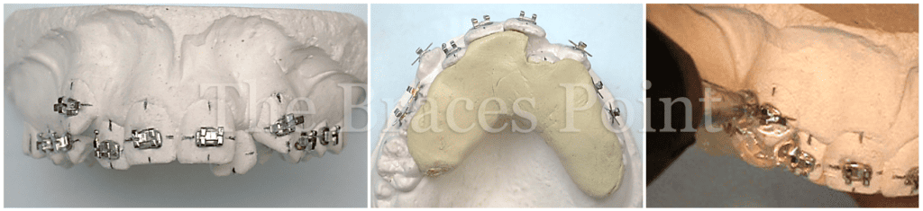 Indirect Bonding Tray 1