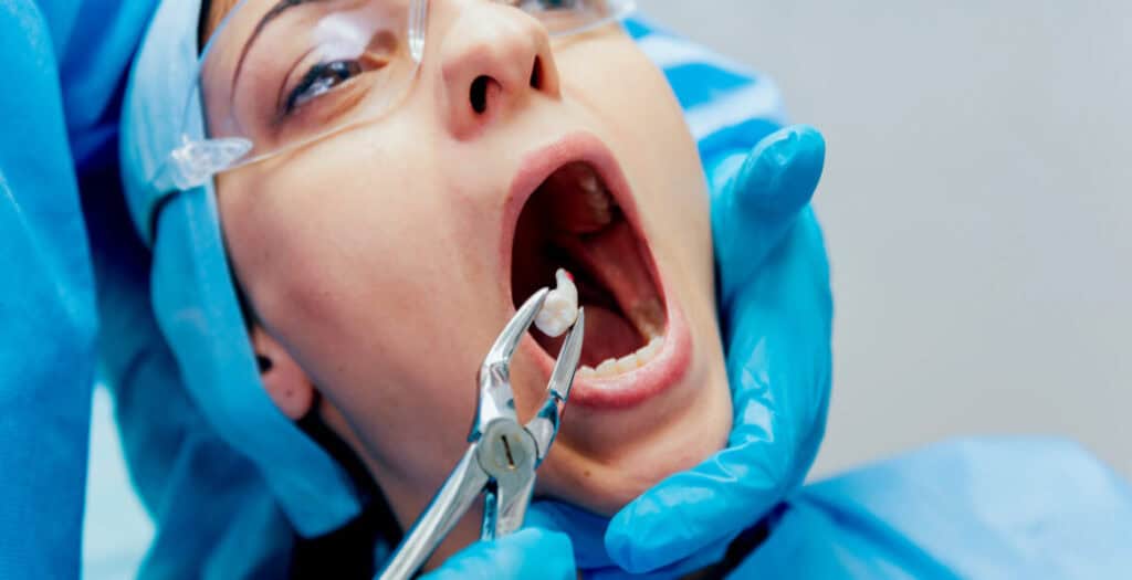 Wisdom Tooth Removal In Andheri West Image 3
