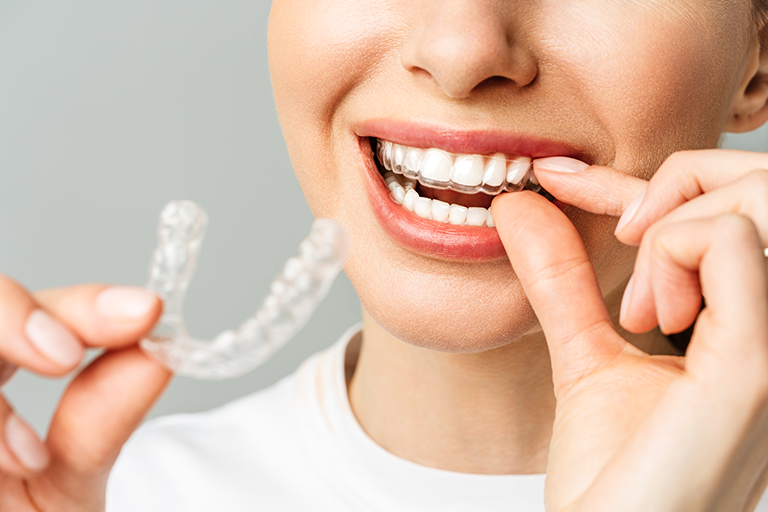 Aligners With Smile