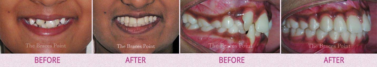 Before And After Orthodontics Thebracespoint 06