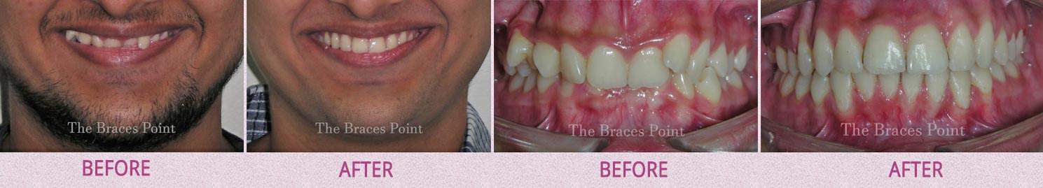 Before And After Orthodontics Thebracespoint 07.1