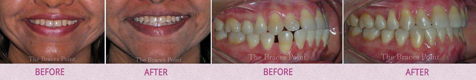 Before And After Orthodontics Thebracespoint 08