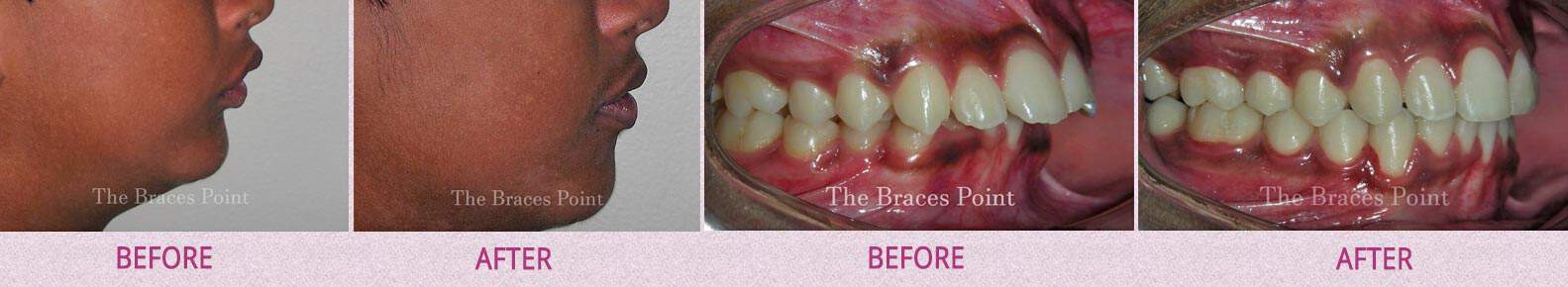 Before And After Orthodontics Thebracespoint 09