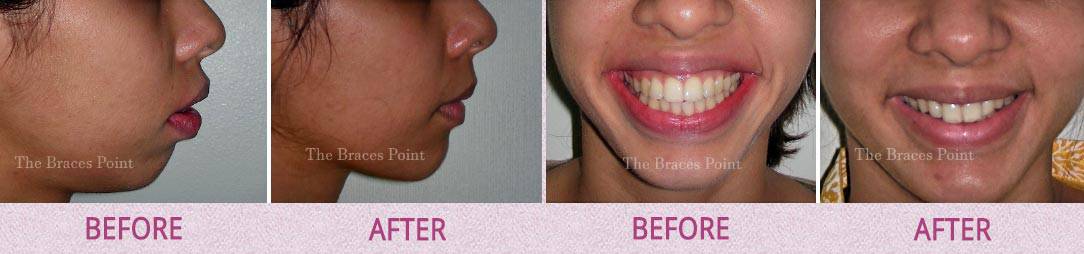 Before And After Orthodontics Thebracespoint 1