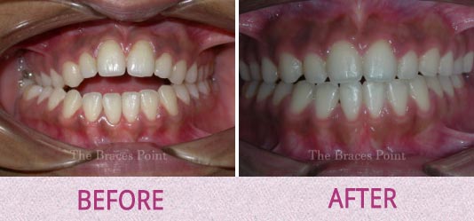 Before And After Orthodontics Thebracespoint 10