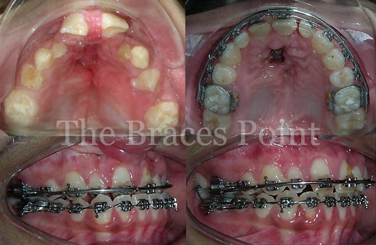 Buccal Expander During Rx