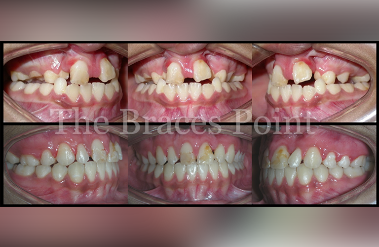 Buccal Expander Rx Result