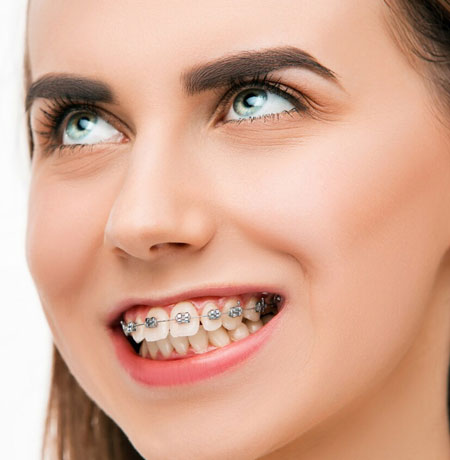 Common Concerns With The Braces