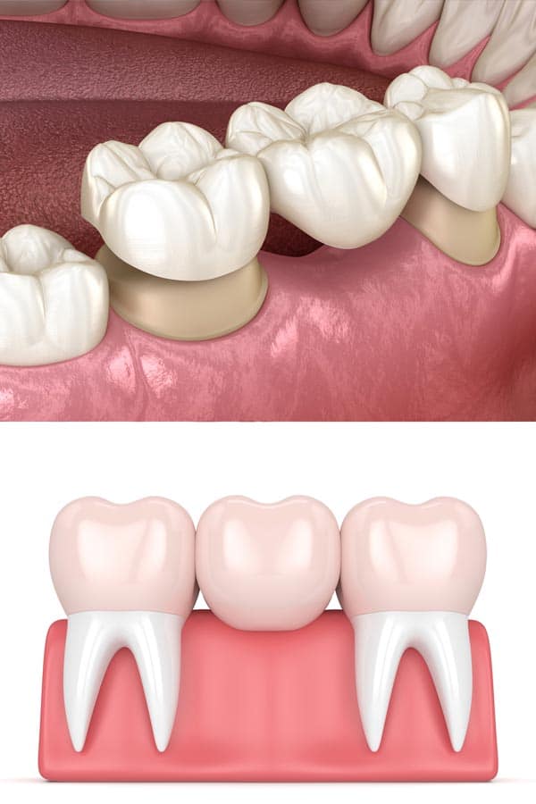 Dental Bridges