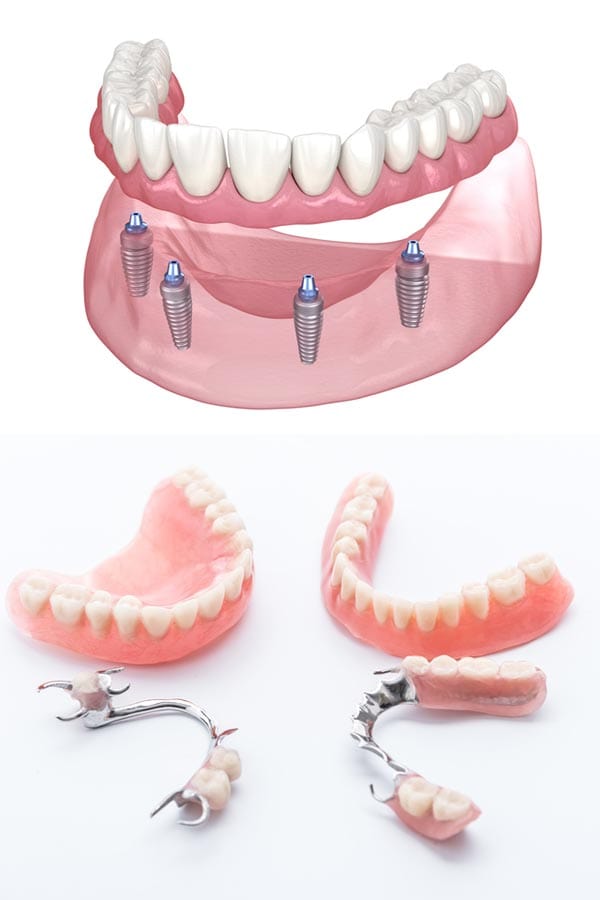 Dental Implants