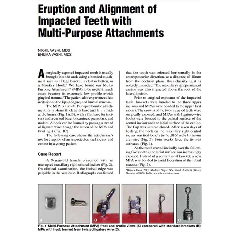 Eruption Alignment Of Impacted Teeth With Mpa