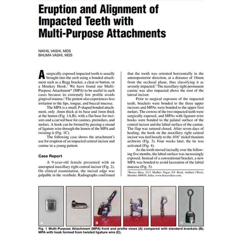 Eruption Alignment Of Impacted Teeth With Mpa