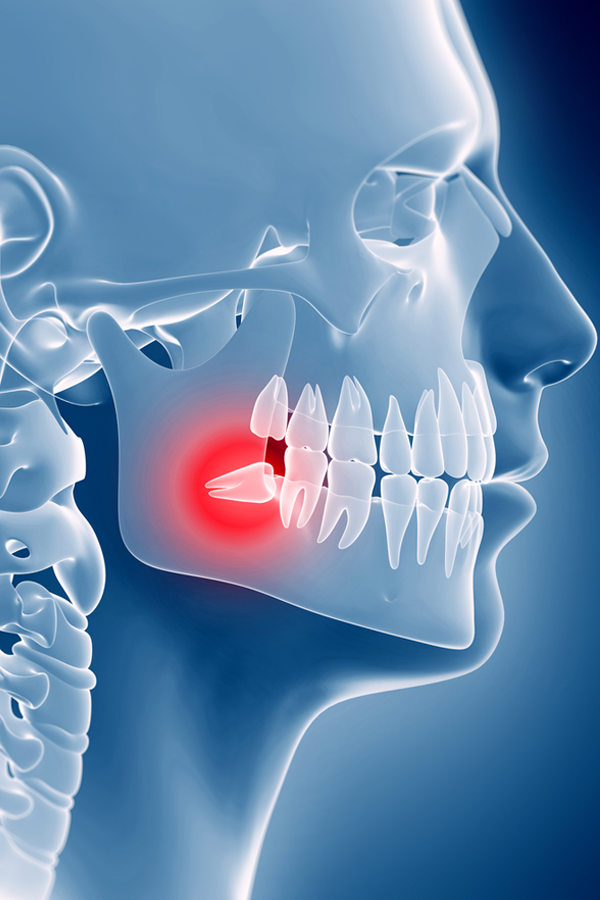 Impacted Teeth Exposure