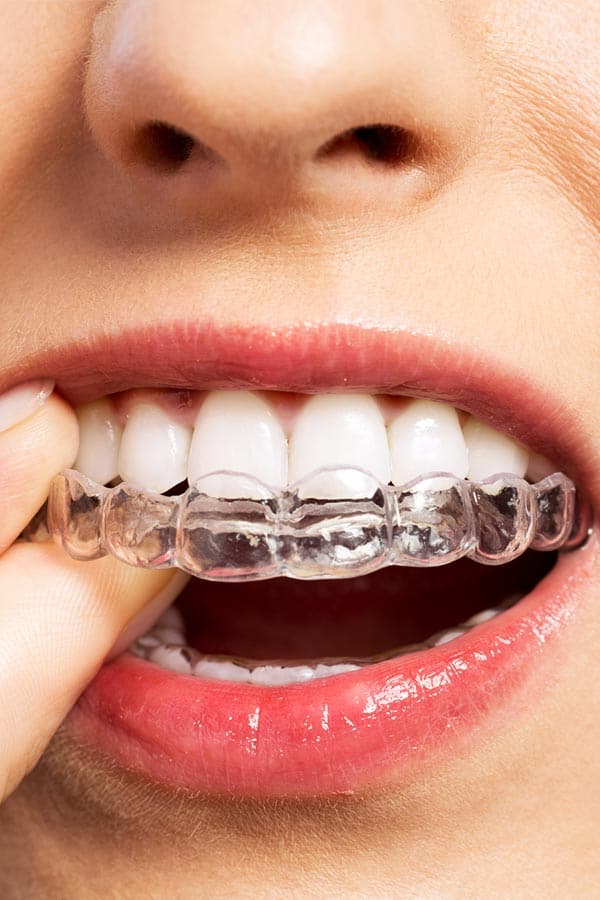 Invisalign And Clear Aligners