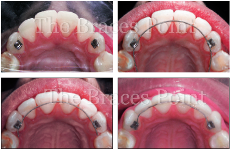 Mpa Bonded Retainer