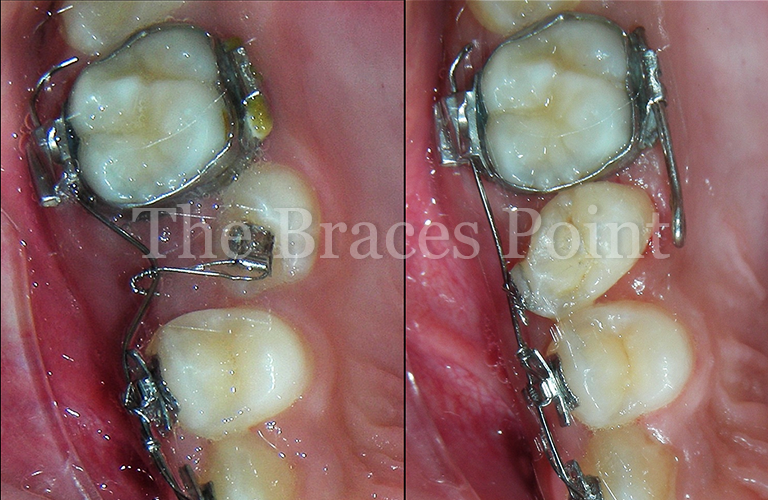 Mpa Rotation Correction