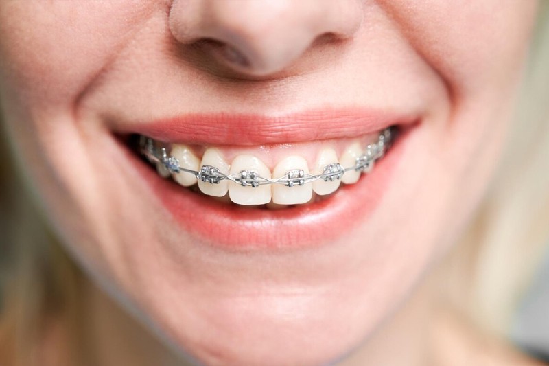 Orthodontic Treatment