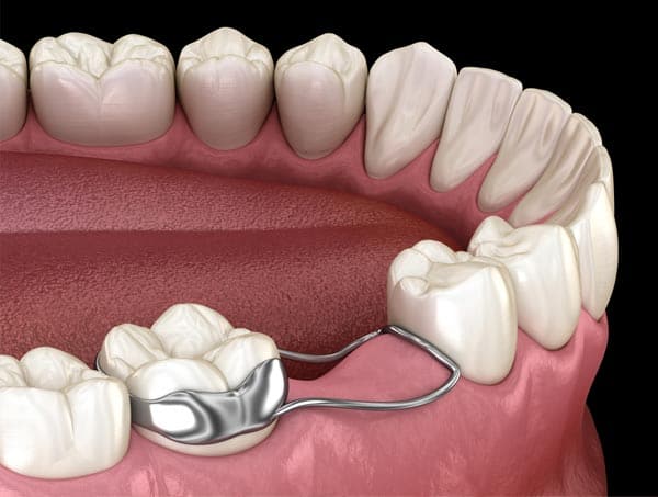 Preserving Space For Permanent Teeth