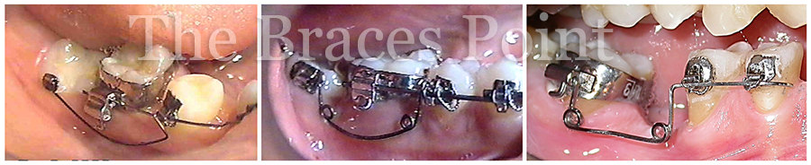 Springs For Molar Correction 01