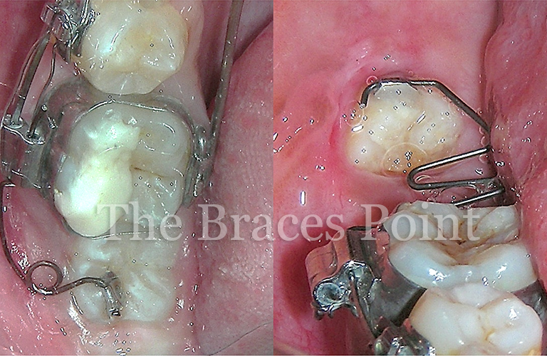 Springs For Molar Correction