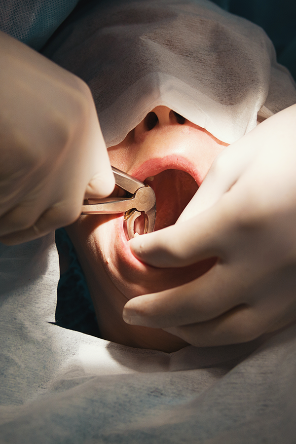 Wisdom Teeth Surgical Extractions